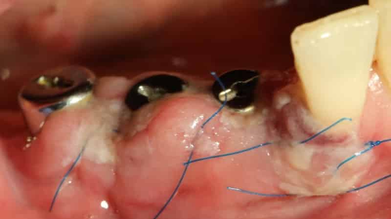 осложнения после имплантации зубов фото