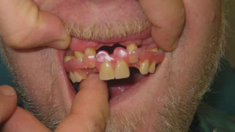 частичный протез зубов