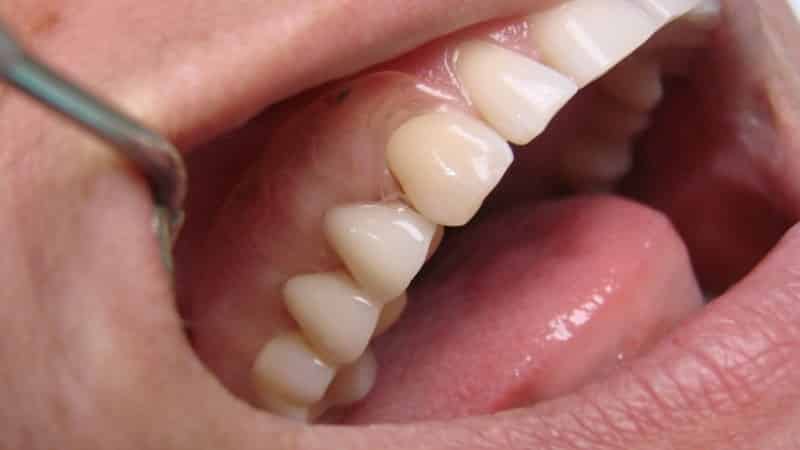 частичное протезирование зубов