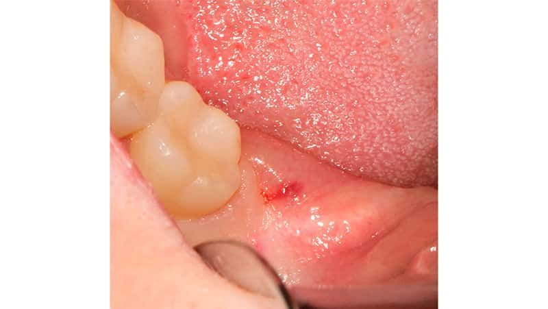 Место удаленного зуба мудрости