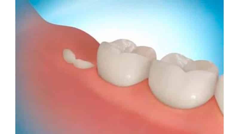 Рост зуба мудрости