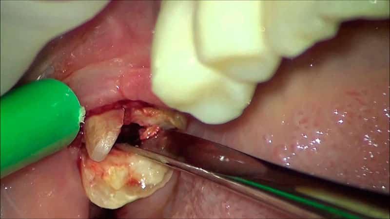 Как происходит удаление зуба мудрости