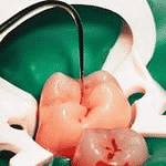 Зубы после витального окрашивания Зубы после витального окрашивания